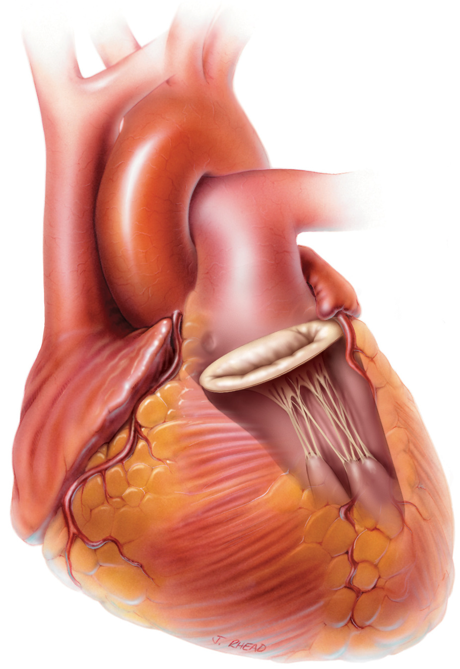 Les pathologies cardiaques - Chirurgiens Cardiaques Associés à Caen