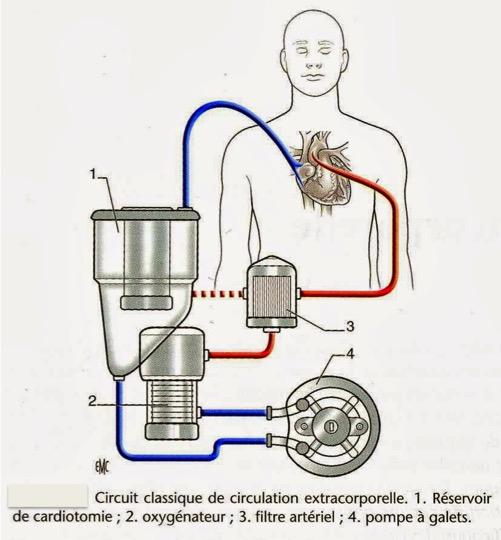 Circulation extra-corporelle - Chirurgiens Cardiaques Associés à Caen