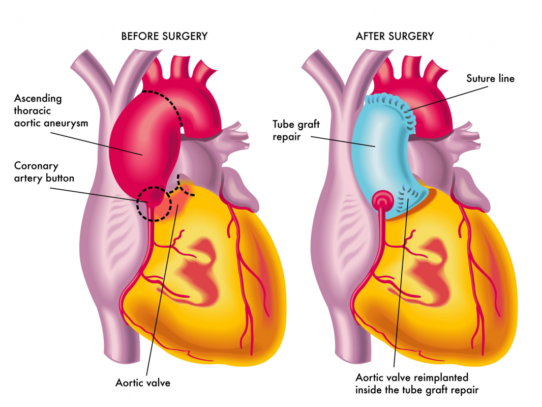 Schéma 6' Chirurgie de réparation d'un anévrisme - Chirurgiens Cardiaques Associés à Caen