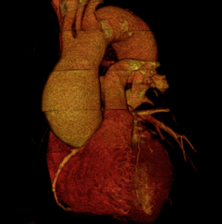 Schéma 6 Reconstruction d'un anévrisme de l'aorte au scanner - Chirurgiens Cardiaques Associés à Caen