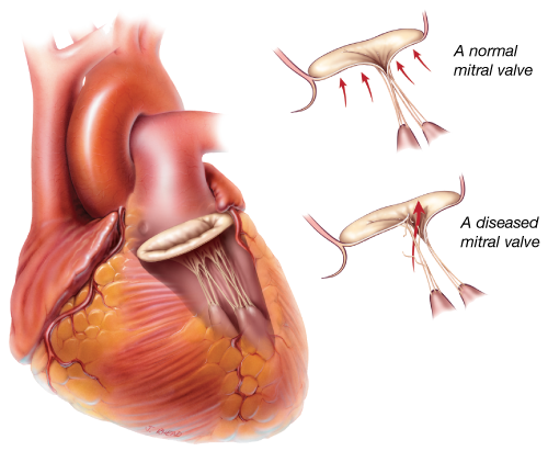 Remplacement valve aortique : Quand faut-il le faire ?