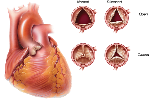 Rétrécissement aortique calcifié - Chirurgiens Cardiaques Associés à Caen