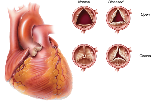 La chirurgie valvulaire - Chirurgie Cardiaque à Caen