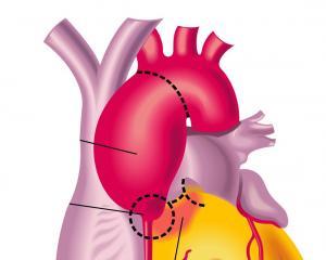 Anévrisme de l'aorte - Chirurgiens Cardiaques Caen